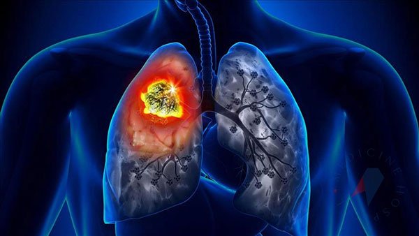 Akciğer kanseri oranında korkutan açıklama | Teşhis oranı artıyor
